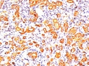 IHC testing of human breast cancer stained with MUC1 antibody (clone GP1.4). Note cytoplasmic and membrane staining.