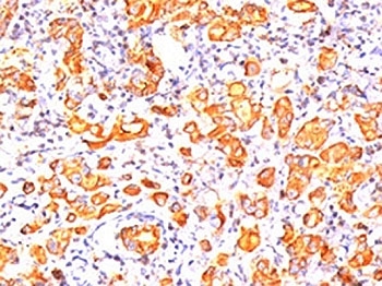 IHC testing of human breast cancer stained with MUC1 antibody (GP1.4). Note cytoplasmic and membrane staining.