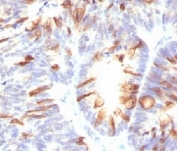 IHC testing of FFPE human colon carcinoma with MUC2 antibody (clone CCP58)