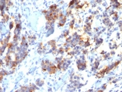 IHC testing of FFPE human gastric carcinoma stained with MUC5AC antibody (clone 45M1).