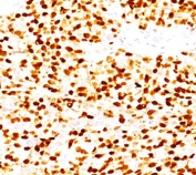 IHC testing of FFPE rhabdomyosarcoma stained with Myogenin antibody (clone MGN185).