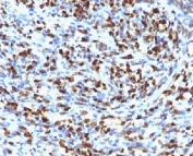 IHC testing of FFPE rhabdomyosarcoma stained with Myogenin antibody (clone MGN185).