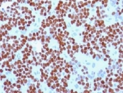 IHC staining of FFPE Ewing's sarcoma with NKX2.2 antibody (clone NX2/294).