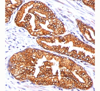 Formalin/paraffin human prostate carcinoma stained with ODC-1 antibody (clone ODC1/485).