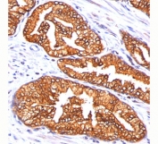 ODC-1 antibody ODC1/485 immunohistochemistry prostate carcinoma (clone ODC1/485).