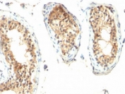 Formalin/paraffin human testicular carcinoma stained with ODC-1 antibody (clone ODC1/485).