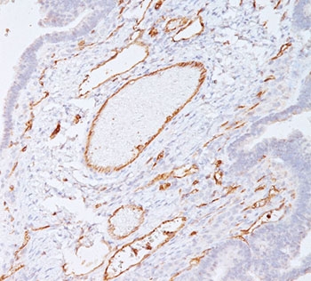 IHC staining of colon carcinoma with PECAM-1 antibody (clone C31.7). Note cell membrane staining of endothelial cells.