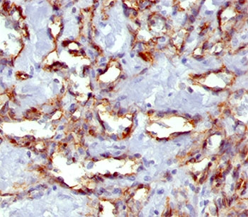IHC staining of angiosarcoma with PECAM-1 antibody (clone C31.7).