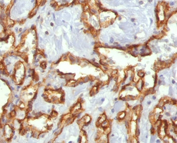 IHC staining of angiocarcinoma with CD31 antibody (C31.3).