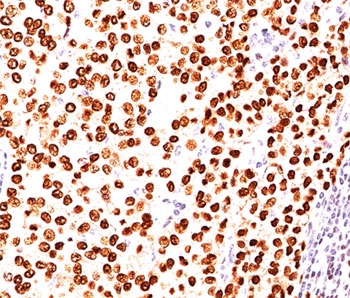IHC testing of FFPE human breast carcinoma stained with Progesterone Receptor antibody (clone PR484).~