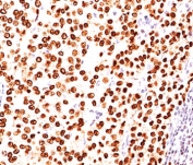 IHC testing of FFPE human breast carcinoma stained with Progesterone Receptor antibody (clone PR484).
