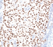 Progesterone Receptor antibody PR500 immunohistochemistry breast carcinoma