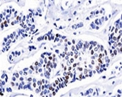 Progesterone Receptor antibody PR501 immunohistochemistry invasive ductal carcinoma
