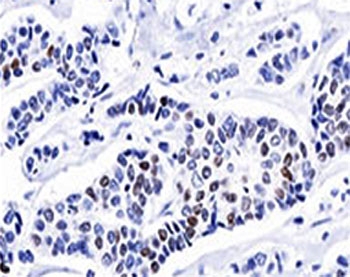 IHC testing of invasive ductal carcinoma stained with progesterone receptor antibody (PR501).
