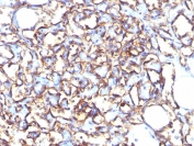 IHC staining of FFPE human angiosarcoma with Podocalyxin antibody (clone 3D3). HIER: boil tissue sections in pH6, 10mM citrate buffer, for 10-20 min and allow to cool before testing.