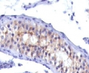 IHC testing of testicular carcinoma with Prolactin receptor antibody (clone PRLR742).