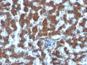 IHC testing of FFPE human hepatocellular carcinoma and RBP antibody (clone G4E4).