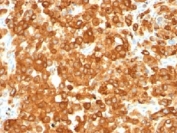 IHC staining of human melanoma with gp100 antibody (clone HMB45). HIER: boil tissue sections in pH 9 10mM Tris with 1mM EDTA for 20 min and allow to cool before testing.