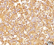IHC staining of human melanoma (20X) with gp100 antibody (clone HMB45). HIER: boil tissue sections in pH 9 10mM Tris with 1mM EDTA for 20 min and allow to cool before testing.