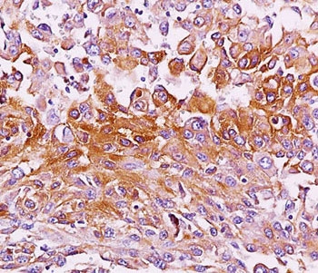 IHC testing of melanoma tissue stained with Melanoma antibody (NKI-beteb). HIER: boil tissue sections in pH 9 10mM Tris with 1mM EDTA for 20 min and allow to cool before testing.~
