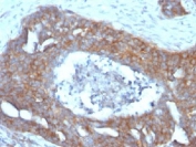 IHC testing of FFPE human ovarian carcinoma with Estrogen Inducible Protein pS2 antibody (clone GE2)