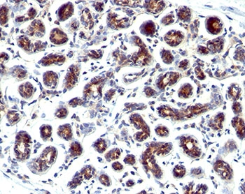 IHC staining of human breast cancer with Estrogen Inducible Protein pS2 antibody.~
