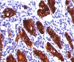 IHC staining of thyroid tissue with Thyroglobulin antibody (2H11).