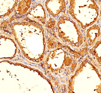 IHC staining of human thyroid tissue with Thyroglobulin antibody (clone 6E1).~