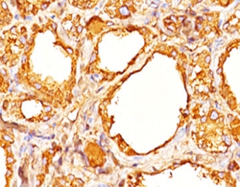 IHC staining of human thyroid tissue with Thyroglobulin antibody cocktail (clones 2H11 + 6E1).