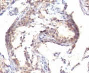 IHC testing of FFPE human testicular carcinoma with TGF alpha antibody (clone MF9)