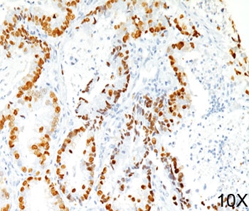 IHC staining of human lung adenocarcinoma (10X) with TTF-1 antibody (8G7G3/1).~
