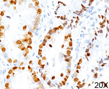 IHC staining of human lung adenocarcinoma (20X) with TTF-1 antibody (8G7G3/1).