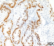 TTF-1 antibody 8G7G3/1 immunohistochemistry lung adenocarcinoma 10X