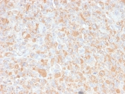 IHC staining of FFPE human histiocytoma with TNF alpha antibody. HIER: boil tissue sections in pH 9 10mM Tris with 1mM EDTA, for 10-20 min and allow to cool before testing.