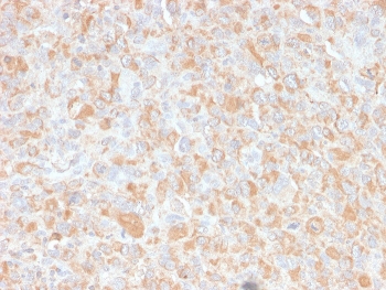 IHC staining of FFPE human histiocytoma with TNF alpha antibody. HIER: boil tissue sections in pH