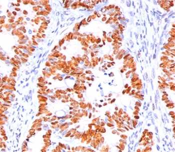 IHC staining of human colon carcinoma with p53 antibody (clone BP53-12).~