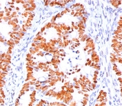 IHC staining of human colon carcinoma with p53 antibody (clone BP53-12).