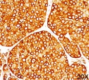 IHC staining of melanoma tissue (20X) with Tyrosinase antibody (T311).