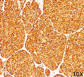 IHC staining of melanoma tissue (10X) with Tyrosinase antibody (T311).~