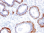 IHC testing of FFPE human prostate cancer with p40 antibody.