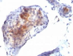 IHC testing of testicular carcinoma with FOXP3 antibody.~