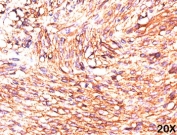 Formalin/paraffin human gastrointestinal stromal tumor (20X) stained with TMEM16A antibody (clone DG1/447).