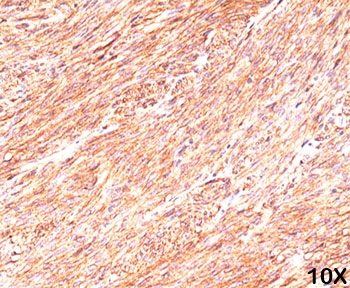 Formalin/paraffin human gastrointestinal stromal tumor (10X) stained with TMEM16A antibody (clone DG1/447).~