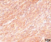 Formalin/paraffin human gastrointestinal stromal tumor (10X) stained with TMEM16A antibody (clone DG1/447).