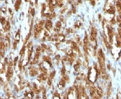 IHC testing of FFPE rhabdomyosarcoma with Muscle Actin antibody (clone HHF35)
