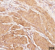 IHC staining of human leiomyosarcoma (20X) with Muscle Actin antibody (HHF35).