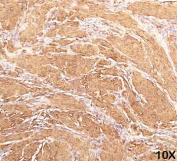 IHC staining of human leiomyosarcoma (10X) with Muscle Actin antibody (HHF35).