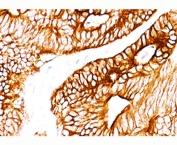 IHC staining of FFPE human colon carcinoma with Cytokeratin 8/18 antibody (K8.8 + DC10).