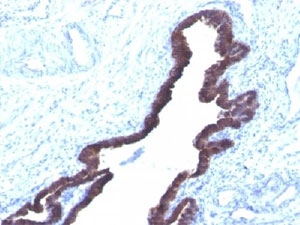 IHC staining of FFPE human ovarian cancer with Cytokeratin 8/18 antibody (K8.8 + DC10).~