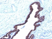 IHC staining of FFPE human ovarian cancer with Cytokeratin 8/18 antibody (K8.8 + DC10).